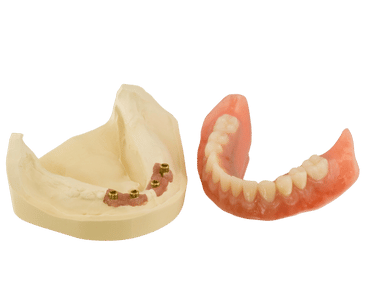 Implant-supported dentures